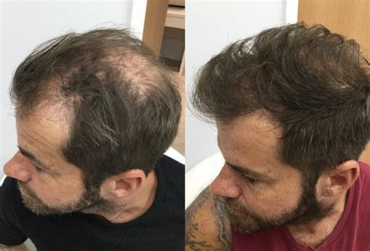 Does hair grow back after smoothening?