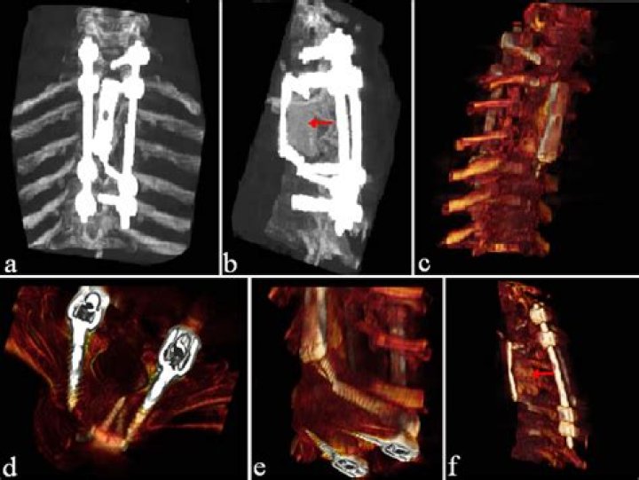 Does leiomyosarcoma come back?