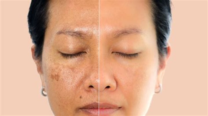Does Murad work on dark spots?