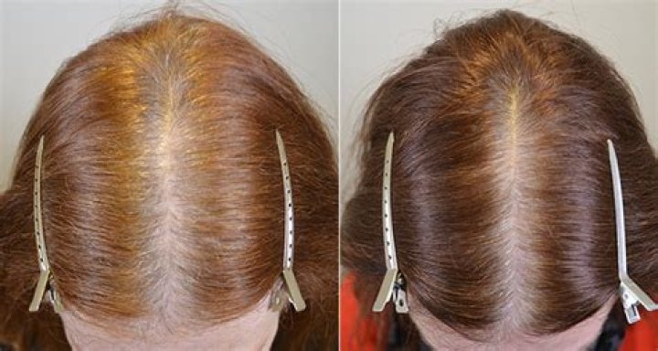 Does Nutrafol work for female pattern baldness?