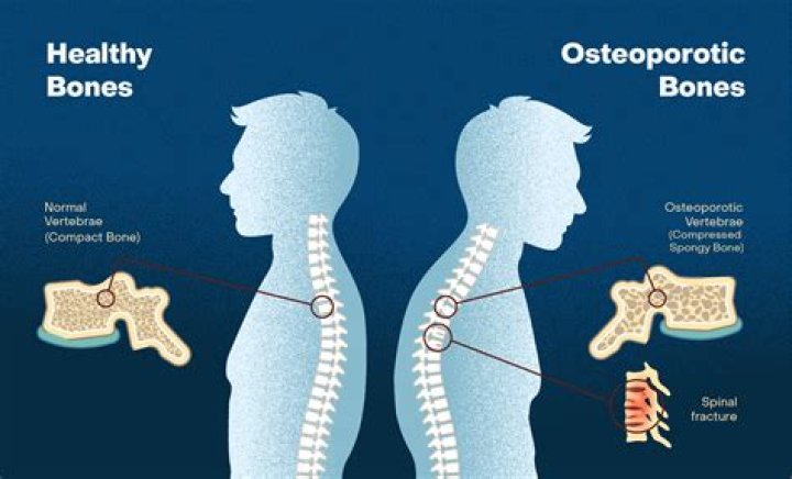 Does osteoporosis cause death?