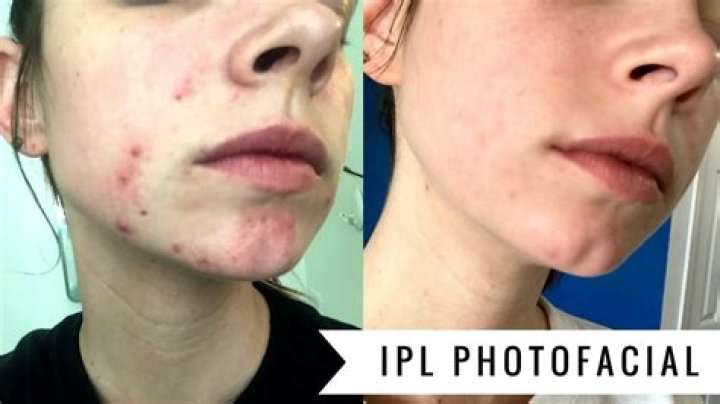 Does Photofacial really work?