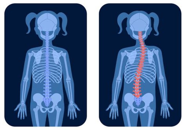 Does scoliosis affect your face?