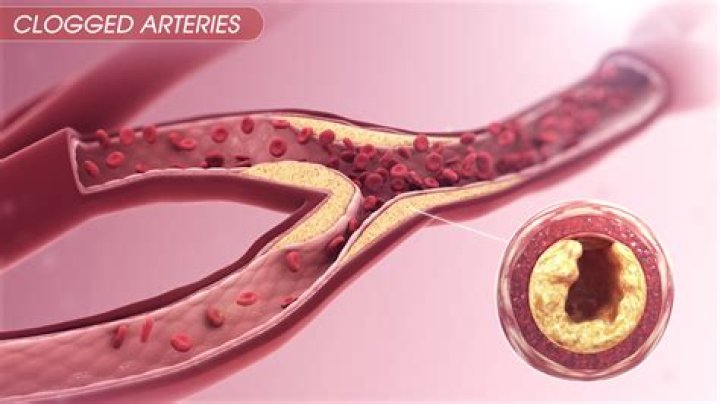 Does sodium clog arteries?