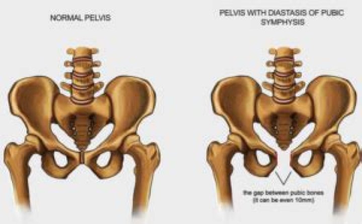 Does symphysis pubis dysfunction go away after delivery?