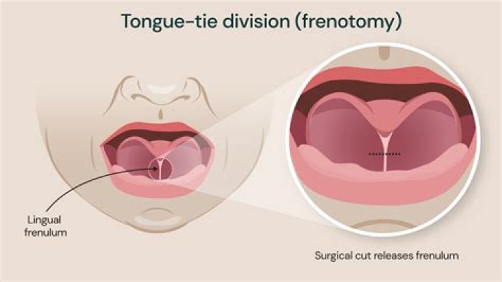 Does tongue tie surgery make tongue longer?