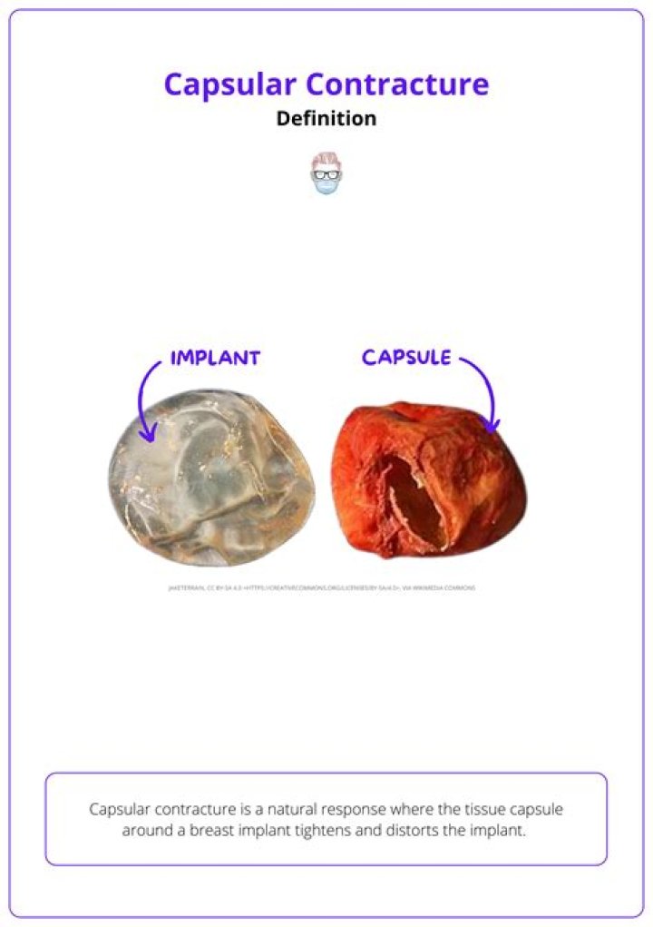 Does Tricare cover capsular contracture?