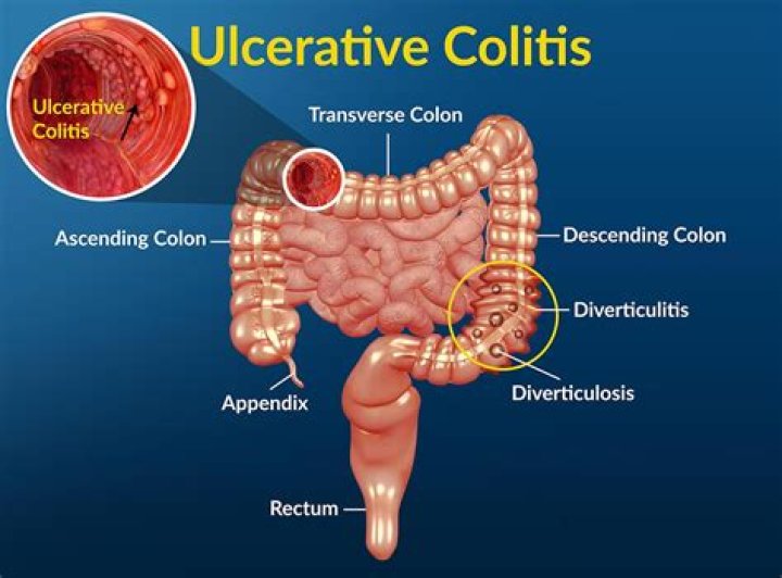 Does ulcerative colitis cause right side pain?