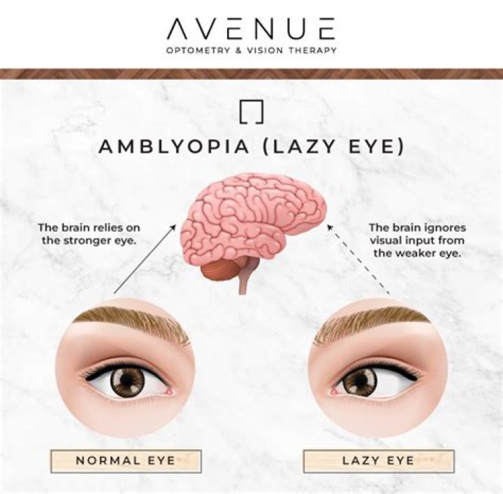 Does vision therapy work for amblyopia?