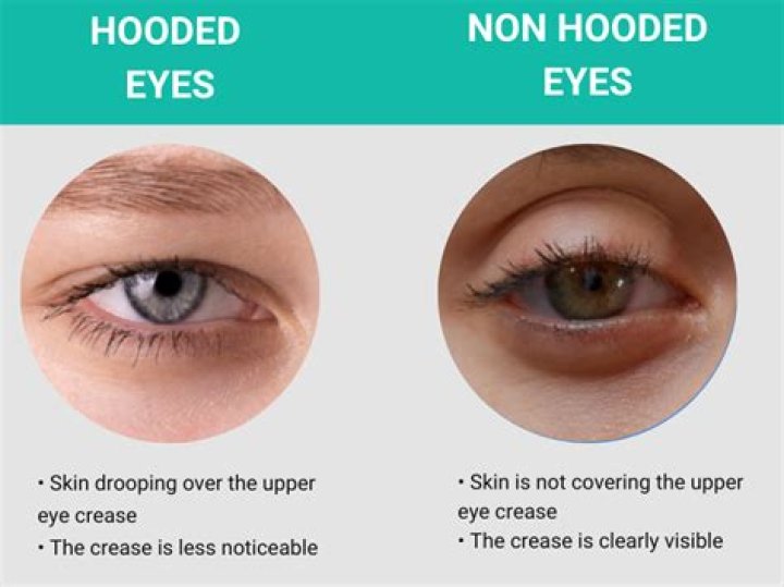 Does weight gain cause hooded eyes?