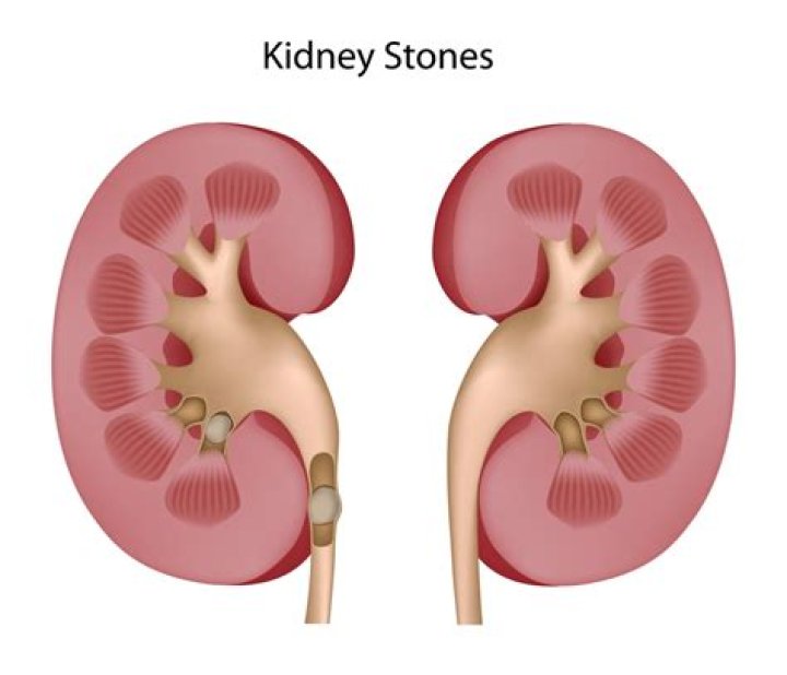 Does your urine smell if you have kidney stones?