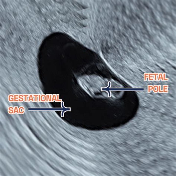 How accurate is sneak peek at 7 weeks?