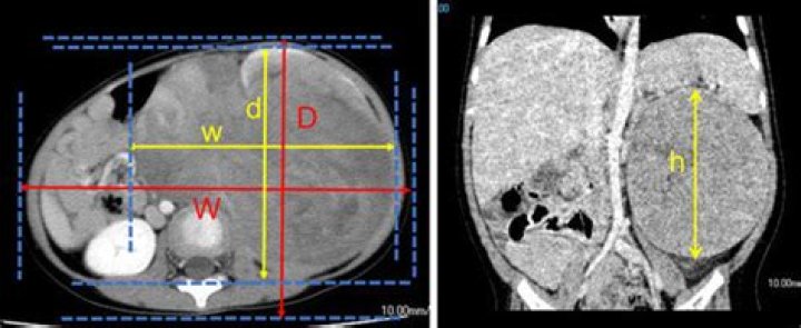 How are tumors measured?