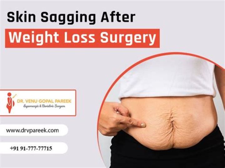 How can I prevent sagging skin after gastric bypass?