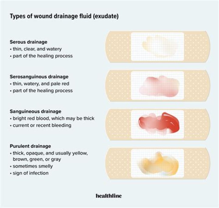 How can Serosanguinous drainage be prevented?