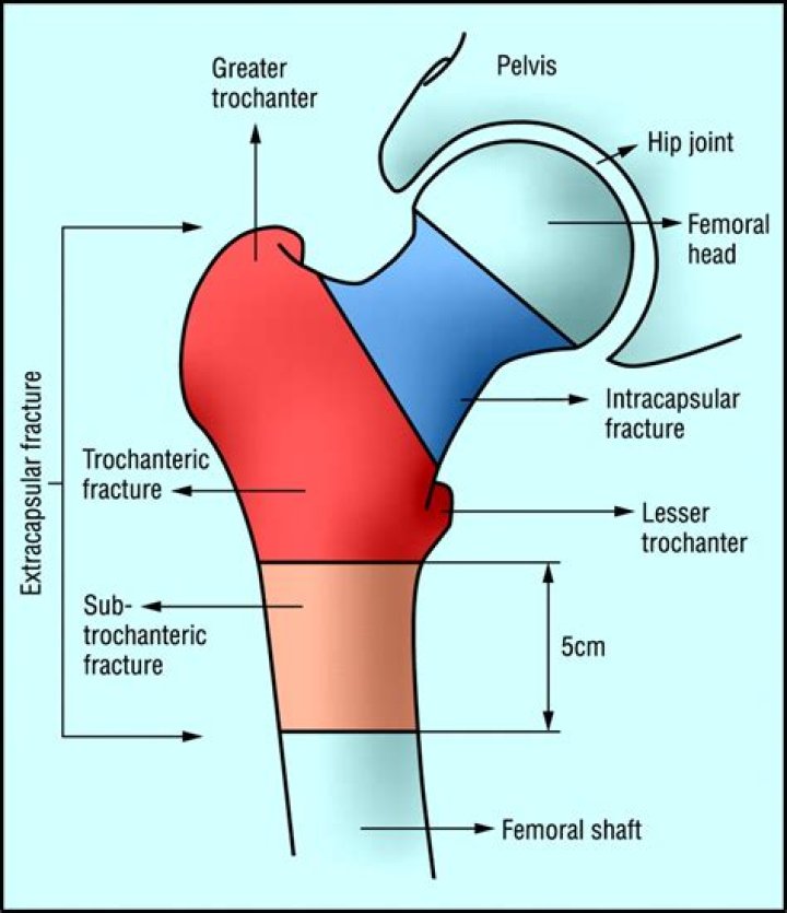 How can subtrochanteric fracture be reduced?