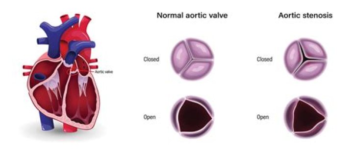 How can you tell the difference between aortic stenosis and Hocm?