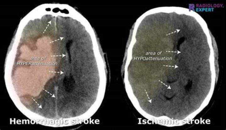 How can you tell the difference between ischemic and hemorrhagic stroke on CT?