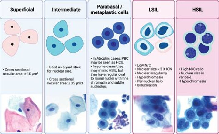 How common is Lsil?