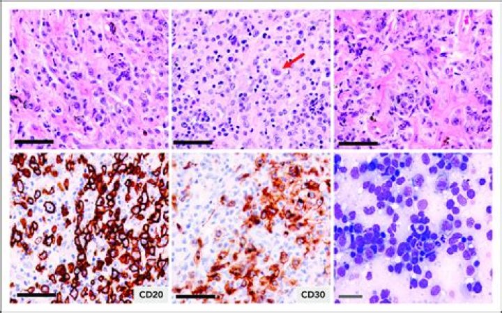 How common is primary mediastinal B cell lymphoma?