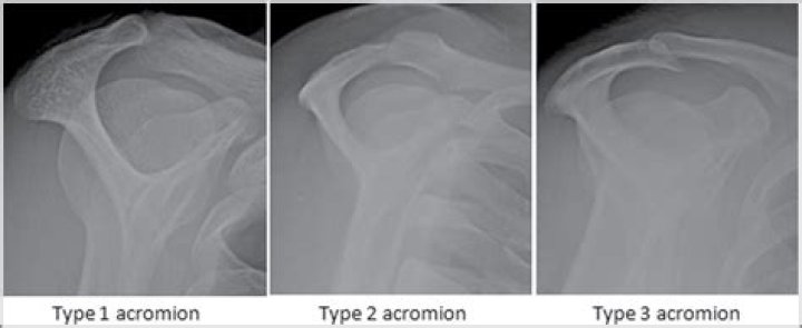 How common is Type 2 acromion?