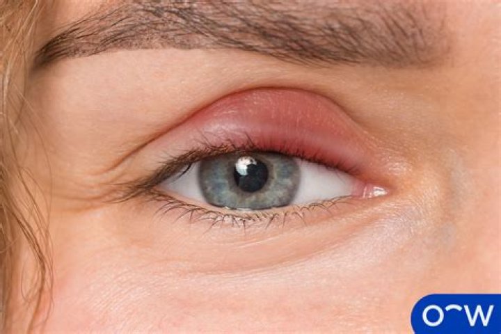 How do allergies affect your eyes?