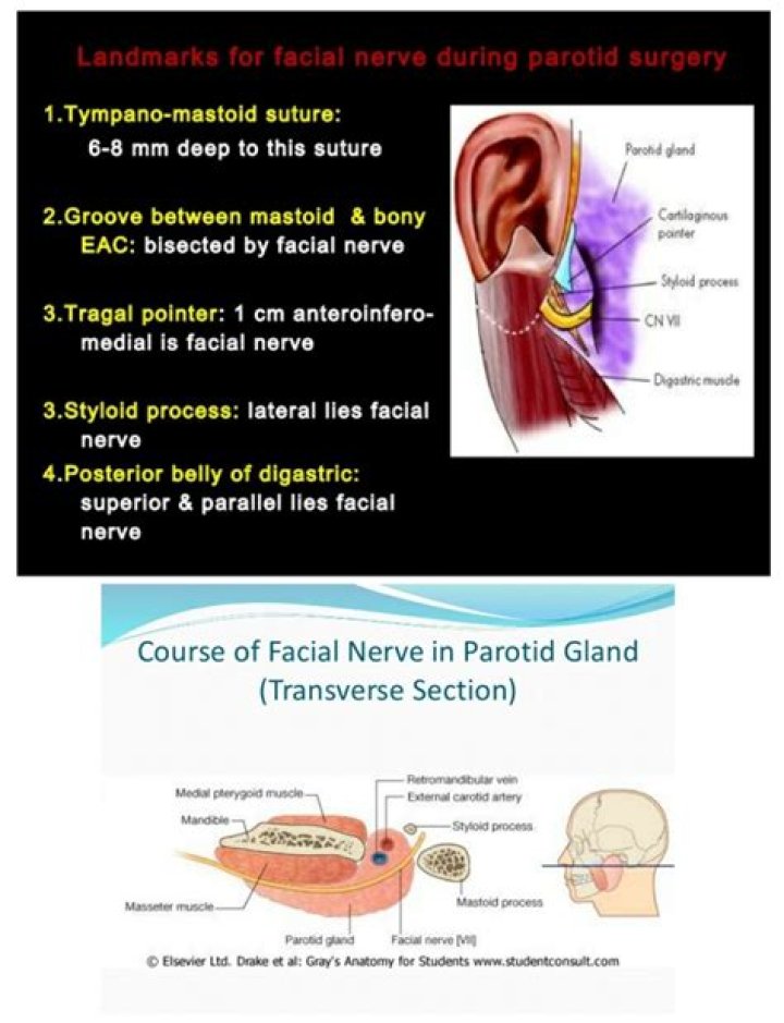 How do I know if I have facial nerve parotid surgery?