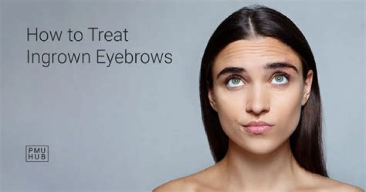 How do I stop ingrown hairs between my eyebrows?
