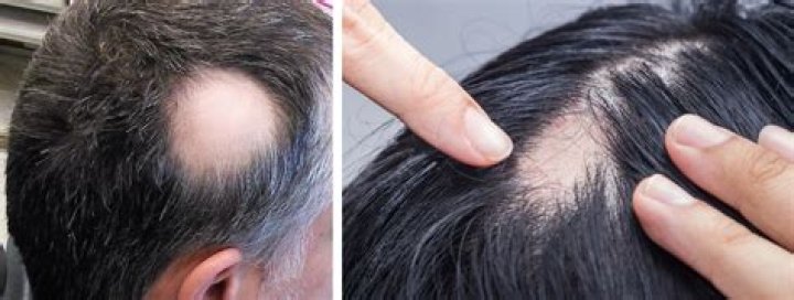 How do men get rid of bald spots?