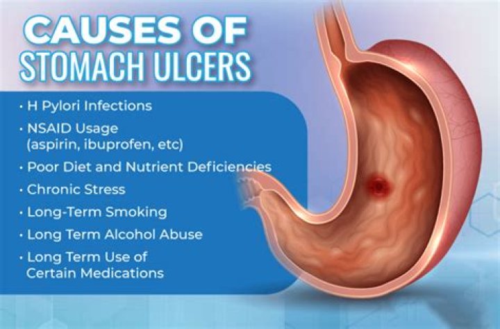How do stomach ulcers develop?