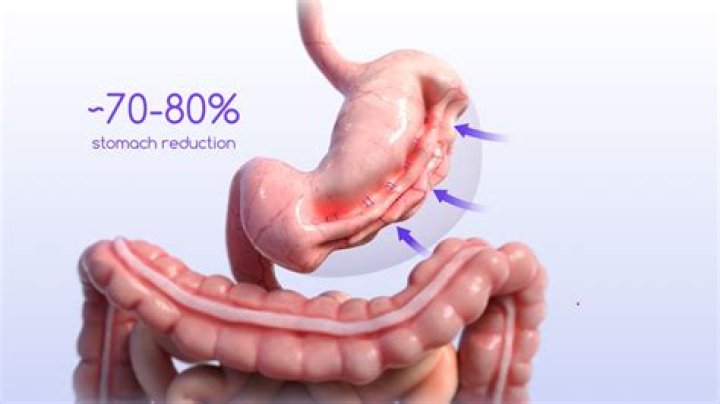 How do you're shrink stomach after gastric sleeve?