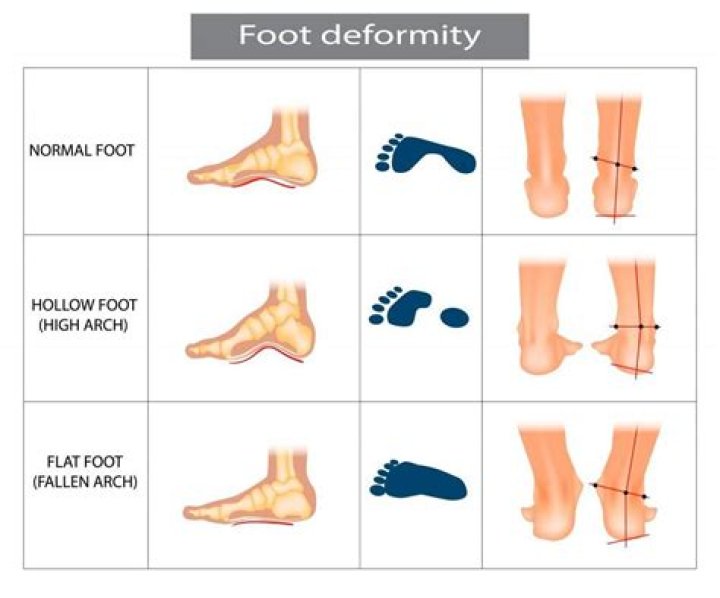 How do you assess flat feet?