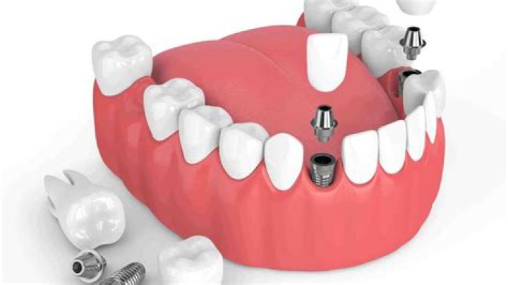 How do you clean a full mouth of dental implants?