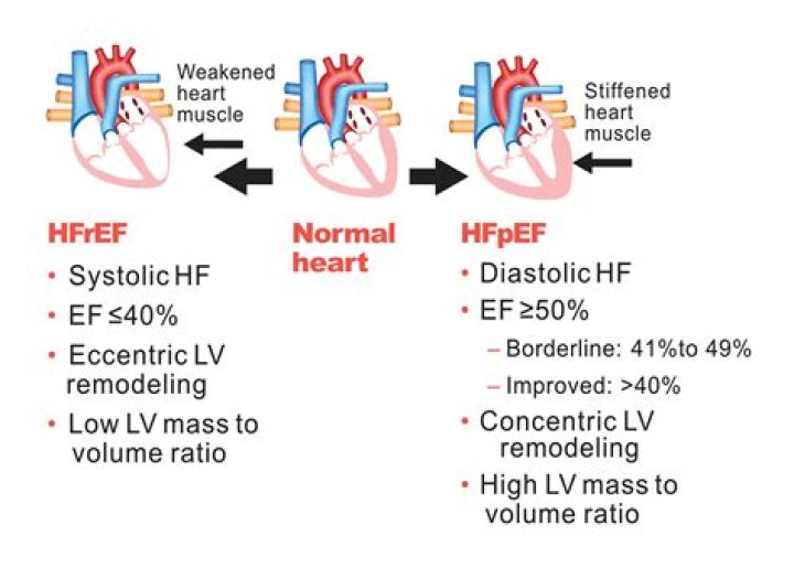How do you diagnose HFpEF?