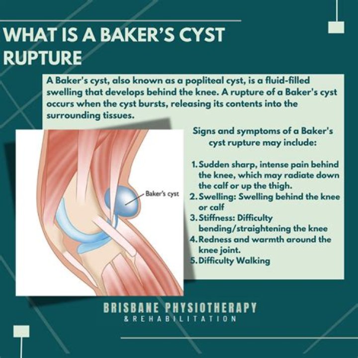 How do you get rid of a cyst behind your ear?
