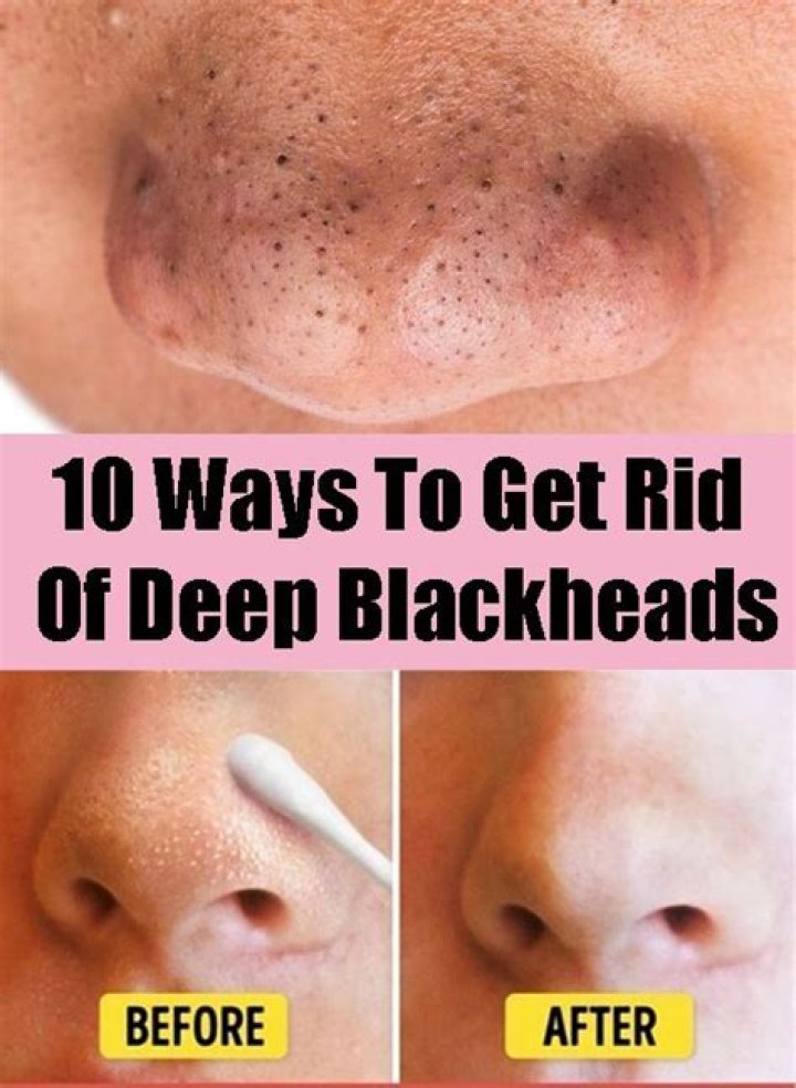 How do you get rid of deep skin blackheads?