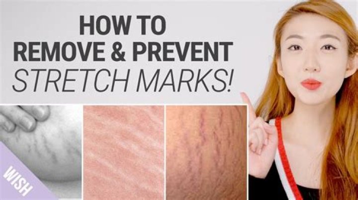 How do you get rid of stubborn stretch marks?