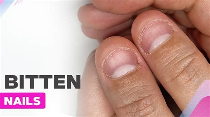 How do you heal a bitten nail?