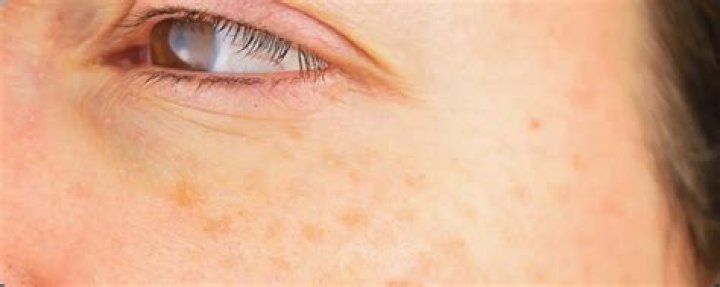 How do you know if a sunspot is cancerous?