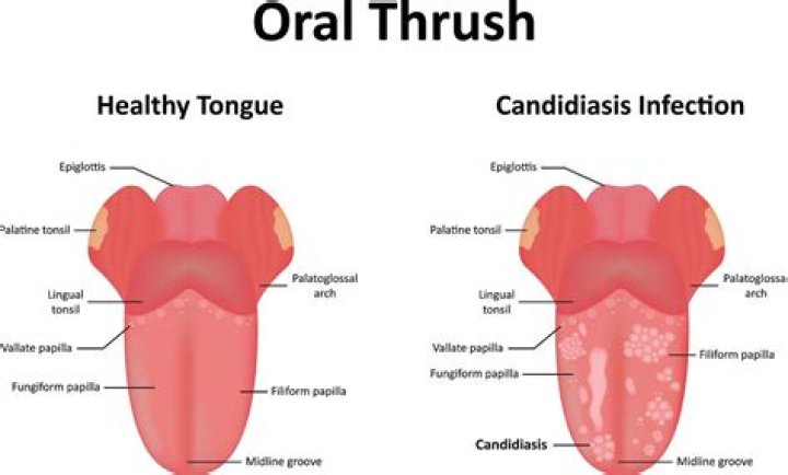 How do you know if you have thrush in your esophagus?