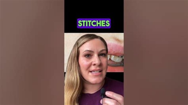 How do you know if you need stitches on lip?