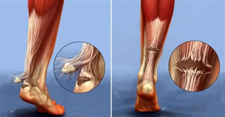 How do you know if you ripped your thumb?