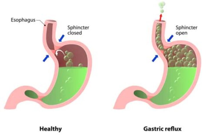 How do you relax the lower esophageal sphincter?
