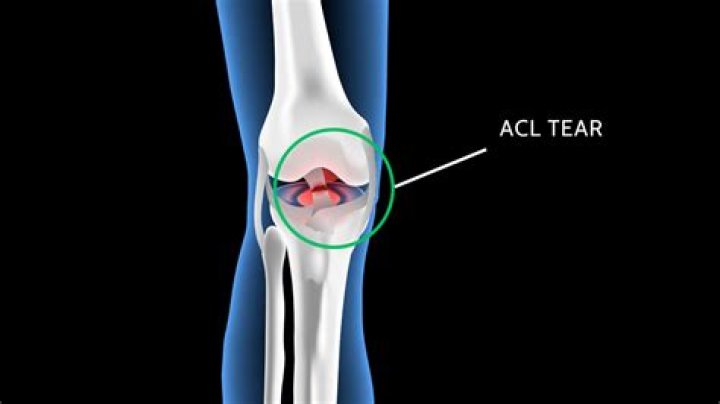 How do you tear your ACL on purpose?