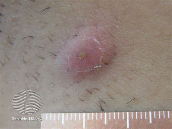 How do you treat an infected armpit cyst?