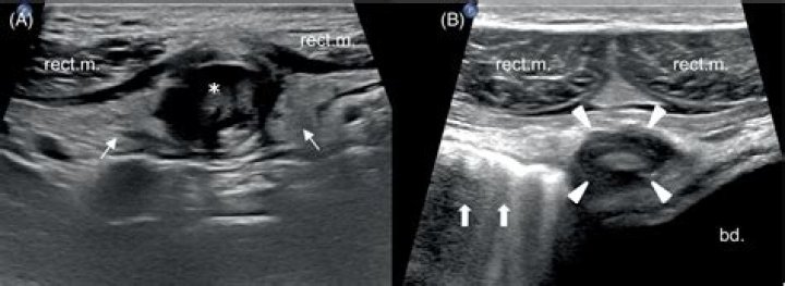 How do you treat an Urachal cyst?
