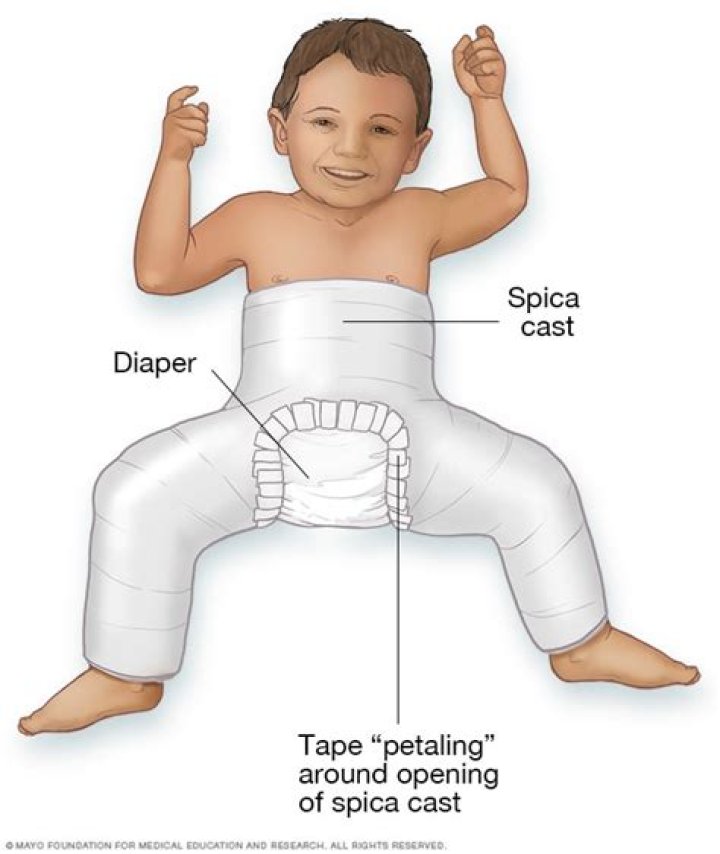 How do you treat hip dysplasia in infants?