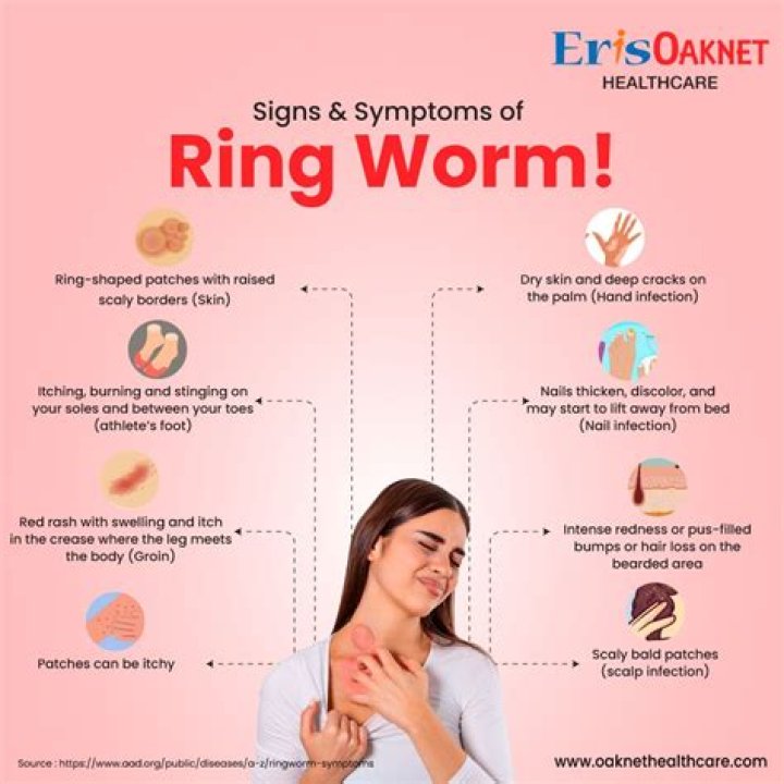 How do you treat ringworm on the skin?