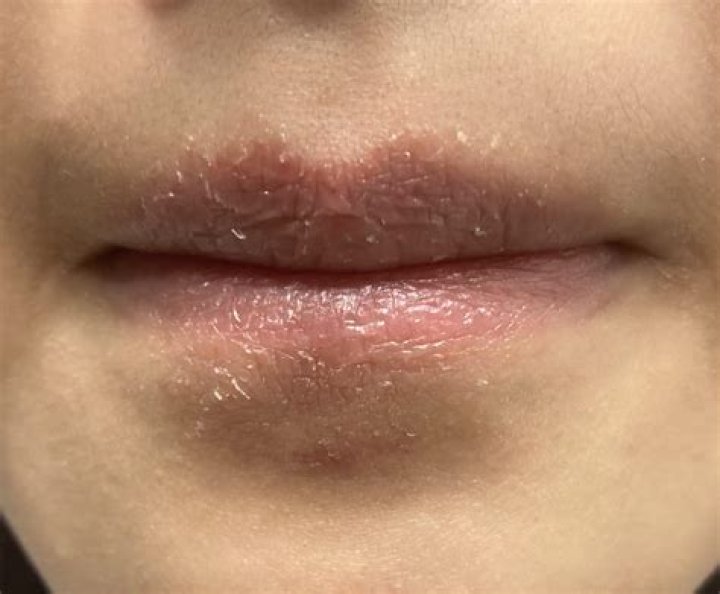 How do you treat sensitive lips?
