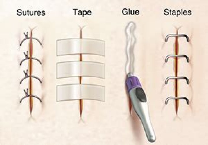 How do you treat surgical glue with an incision?